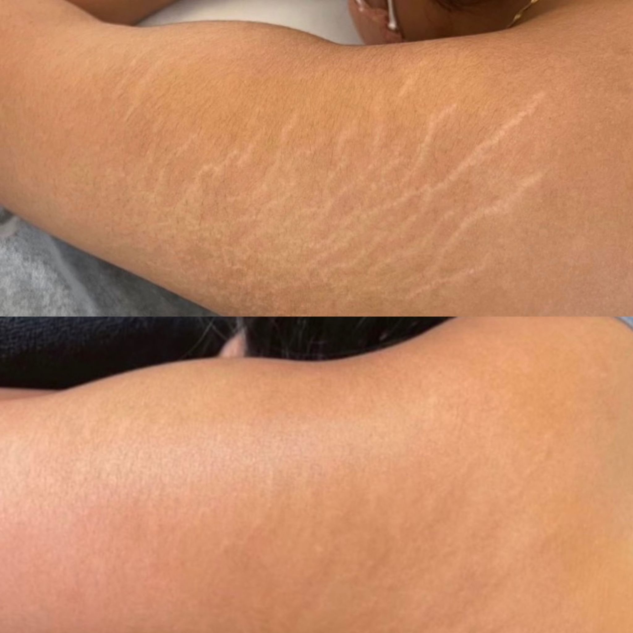 Stretch-before-after