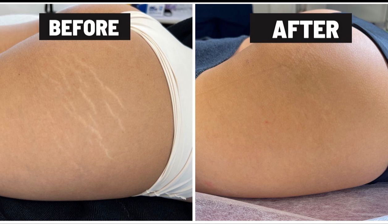 inkless-stretch-mark-revision-after